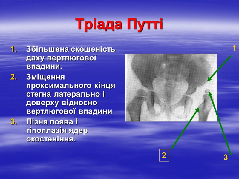 Тріада Путті Збільшена скошеність даху вертлюгової впадини. Зміщення проксимального кінця стегна латерально і доверху